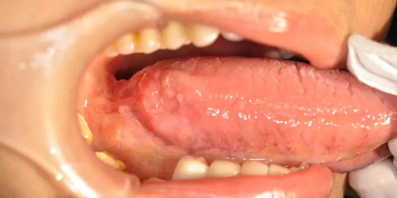 Nổi hạch dưới lưỡi có phải là dấu hiệu cảnh báo ung thư lưỡi