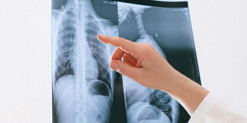 Nội soi màng phổi giúp quan sát trực tiếp tổn thương và lấy sinh thiết chính xác