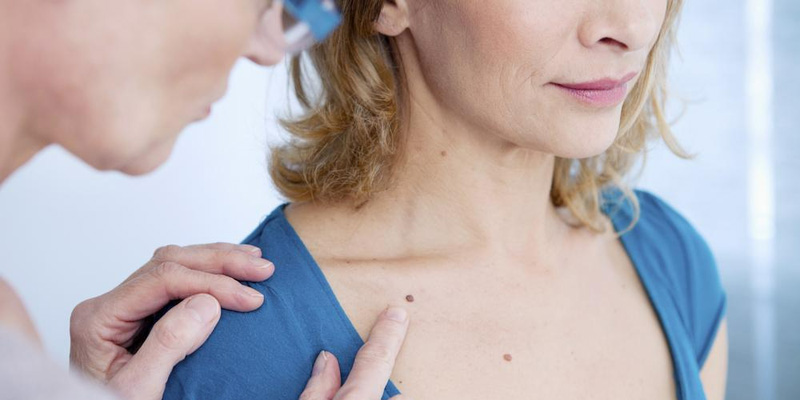 Nốt ruồi là một trong những tổn thương lành tính thường gặp trên da