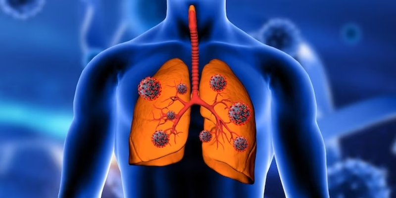 Phân biệt khối u lành tính và ác tính dựa trên các đặc điểm đặc hiệu cho bệnh