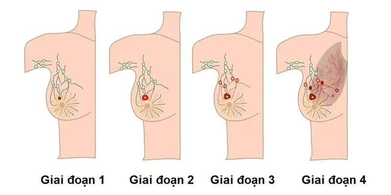 Nhận biết u vú lành tính và ung thư vú dựa vào tốc độ phát triển bệnh