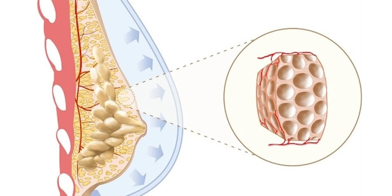Thay đổi xơ nang thường lành tính