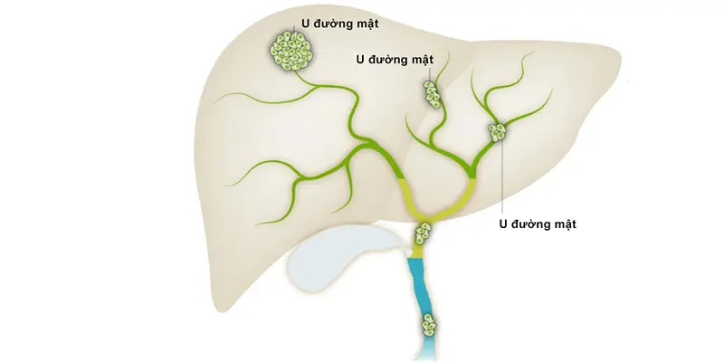 Ung thư đường mật (các vị trí trên đường mật)