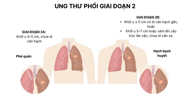 Ung thư phổi giai đoạn 2 được chia thành 2 nhóm 2A và 2B