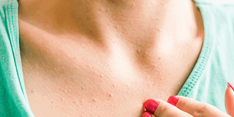 Phát ban như một triệu chứng ban đầu của ung thư vú