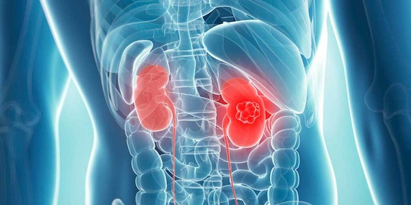 Các khối u thận phần lớn là u ác tính