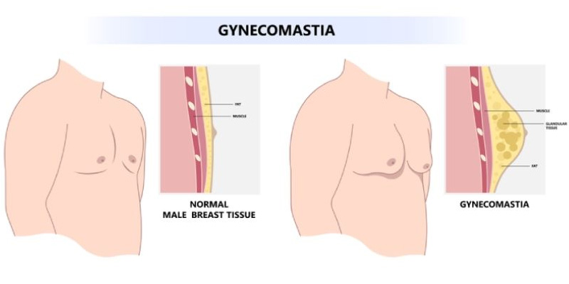 Phì đại tuyến vú ở nam giới là một tình trạng tăng sinh lành tính của tuyến vú
