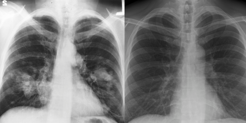 Hình ảnh phổi trắng khi chụp X-quang