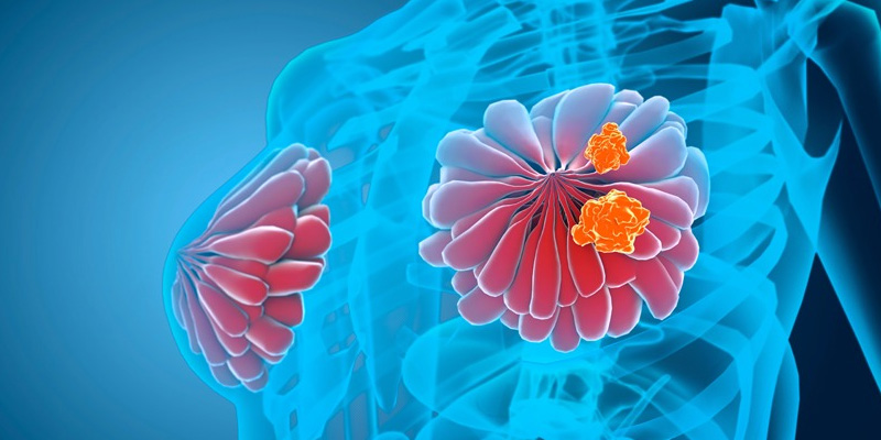 Tốc độ phát triển của ung thư có thể khác nhau, việc phát hiện sớm có thể mang lại kết quả tốt hơn.