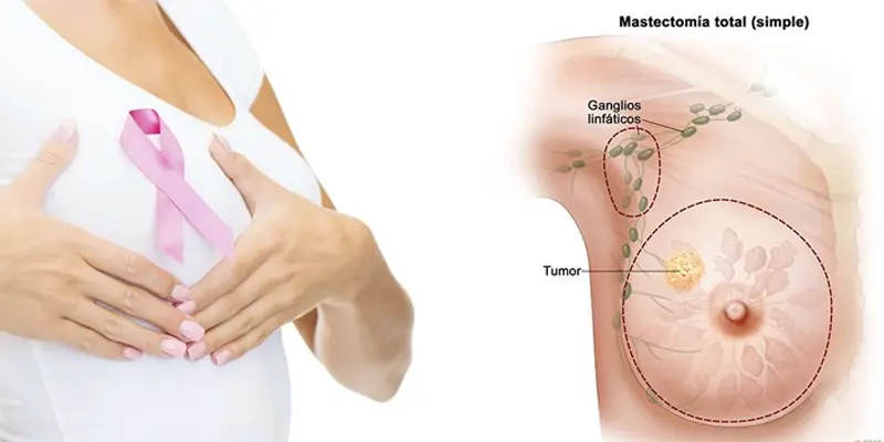 Nếu trong gia đình có người mắc ung thư vú có thể gia tăng nguy cơ mắc ung thư vú
