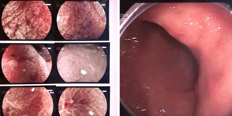 Nội soi dạ dày để chẩn đoán chính xác xem bạn có bị ung thư dạ dày không