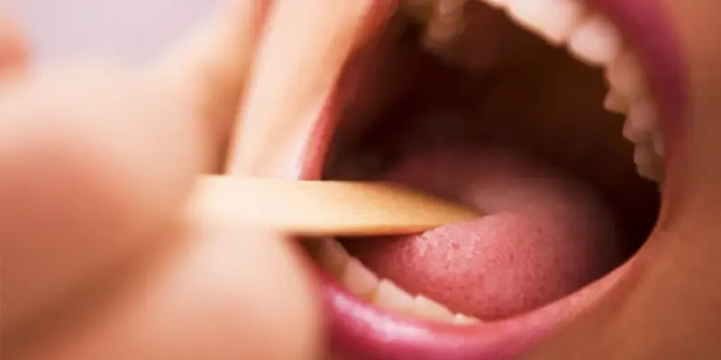 Chẩn đoán ung thư lưỡi bằng cách thăm khám lâm sàng