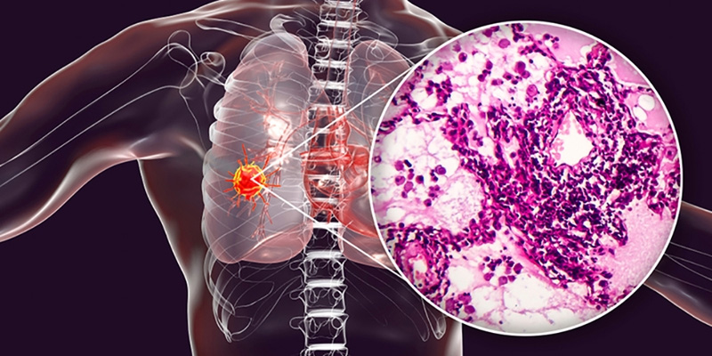 Các phương pháp điều trị ung thư biểu mô tuyến phổi