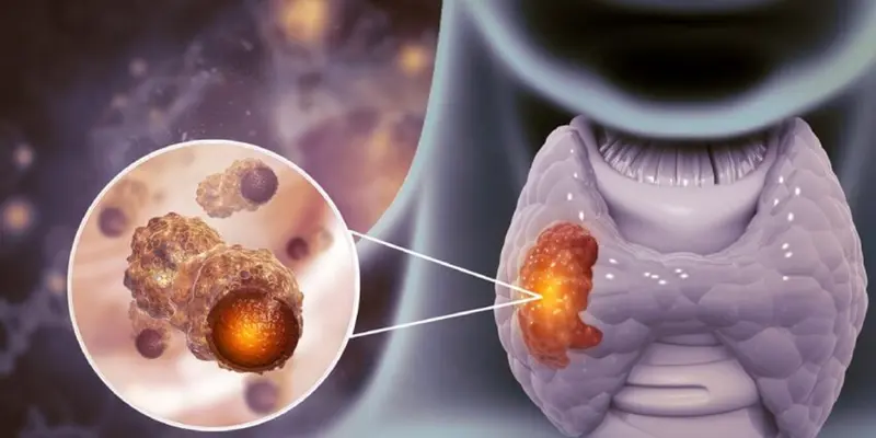 Điều trị ung thư tại tuyến cận giáp cần được thực hiện nhanh chóng