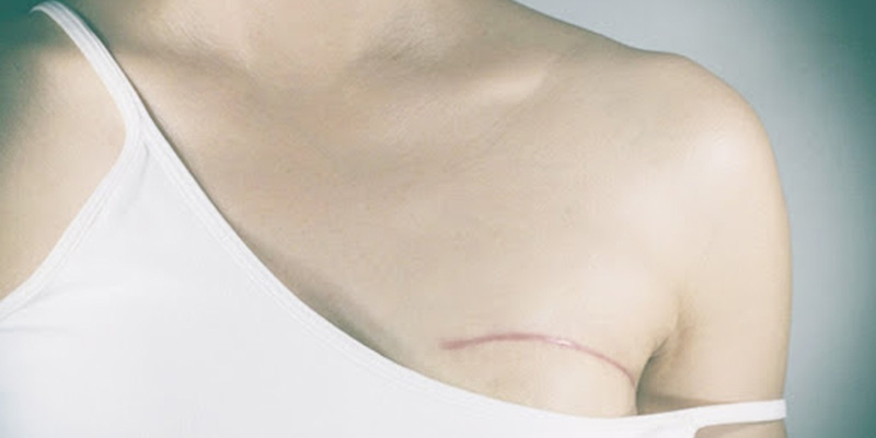 Sử dụng phương pháp phẫu thuật để điều trị ung thư vú thể ống dạng nhỏ