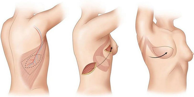 Hình ảnh minh họa phẫu thuật tái tạo vú bằng vạt LD