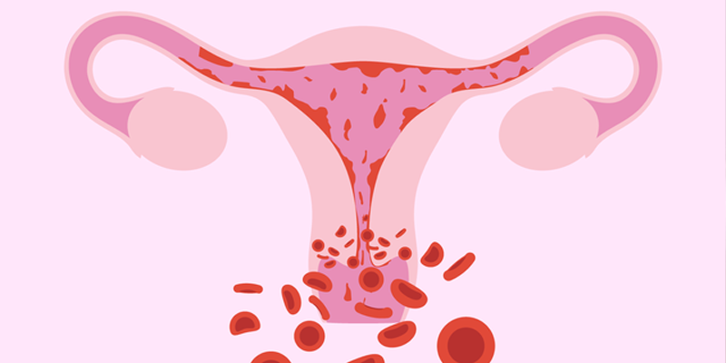 Xuất huyết âm đạo bất thường là triệu chứng thường gặp nhất của polyp tử cung