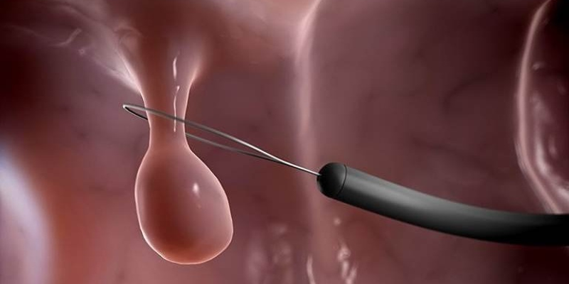 Cắt bỏ polyp được khuyến cáo khi polyp có kích thước lớn và có các triệu chứng khó chịu
