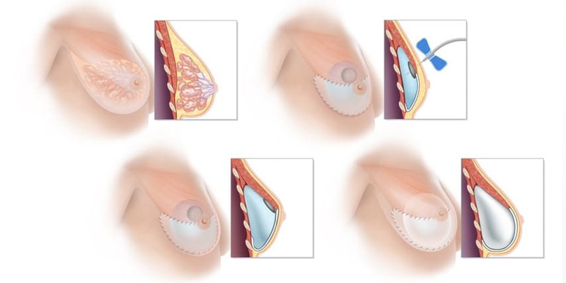 Tái tạo bằng túi giãn mô, sau cơ ngực 1 phần, sau đó thay bằng túi ngực