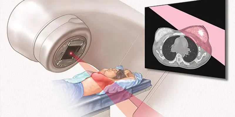 Sau buổi xạ trị ung thư vú, người bệnh có thể tự do hoạt động và sinh hoạt như thường ngày