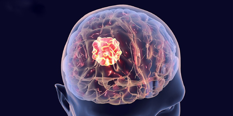 Sinh thiết là bước xác định cuối cùng ung thư não