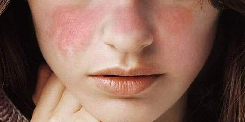 Lupus ban đỏ cũng có thể dẫn tới suy tuỷ xương