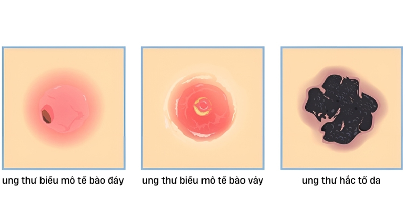 Ung thư da có 3 dạng phổ biến gồm ung thư biểu mô tế bào đáy, ung thư tế bào vảy và ung thư hắc tố