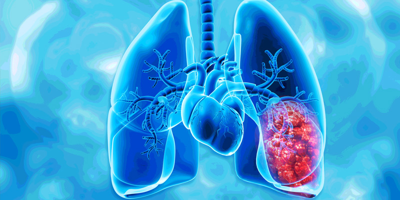 Khi ung thư phổi có triệu chứng rõ ràng, bệnh thường đã ở giai đoạn muộn, khiến việc điều trị trở nên khó khăn