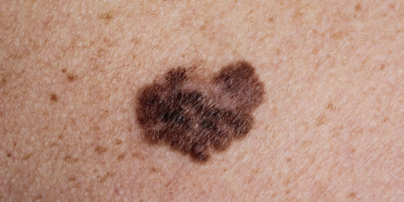 Ung thư sắc tố (melanoma) phát sinh từ tế bào tạo sắc tố da