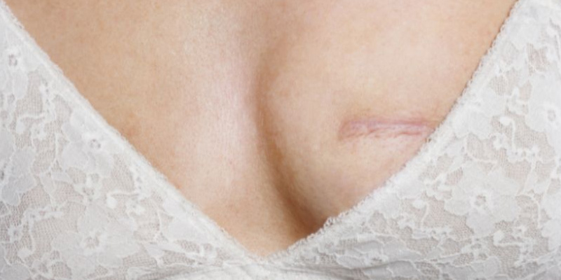 Mổ u vú sau 6 tuần trở đi người bệnh sẽ hồi phục hoàn toàn, sẹo có thể hình thành