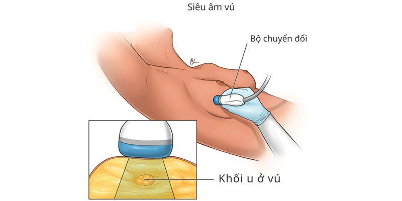 Siêu âm vú có thể phát hiện các tổn thương nghi ngờ ung thư vú