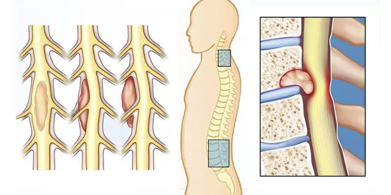 Thực trạng người mắc bệnh ung thư tủy sống hiện nay