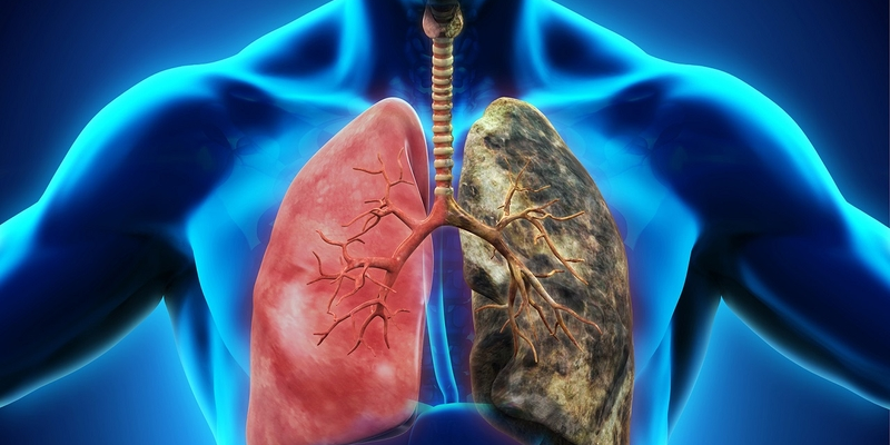 Crizotinib là một loại thuốc thường được sử dụng trong các giai đoạn nặng của ung thư phổi