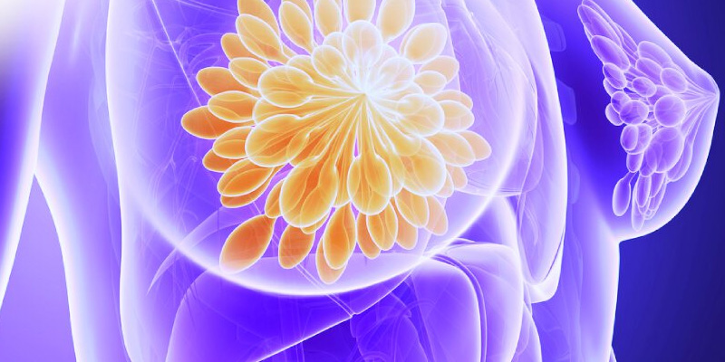 Người bệnh ung thư vú giai đoạn 2 có tỷ lệ sống tương đối trong 5 năm là 87%-99%, tùy thuộc vào tình trạng ung thư có di căn đến hạch bạch huyết không.