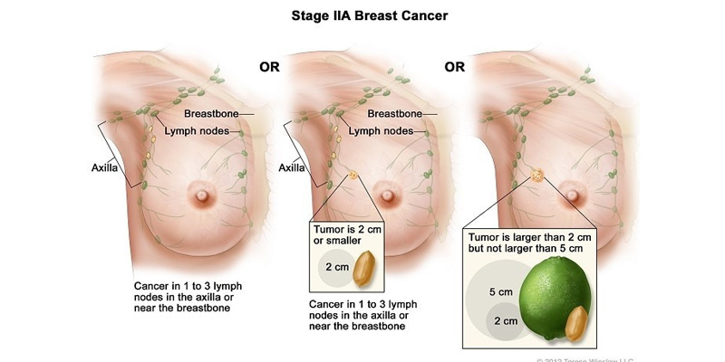 Ung thư vú giai đoạn 2 được chia thành hai phần nhỏ hơn là IIA và IIB