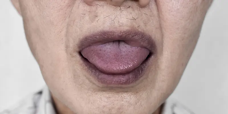 Lưỡi tím cảnh báo nguy cơ bệnh nhân mắc ung thư lưỡi