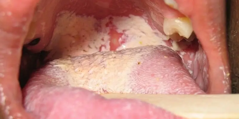 Viêm lưỡi là một trong những bệnh lý liên quan đến tình trạng lưỡi tím