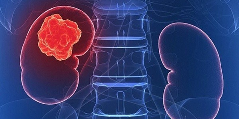 Ung thư thận là căn bệnh có tỷ lệ mắc đứng thứ 9 ở người trưởng thành