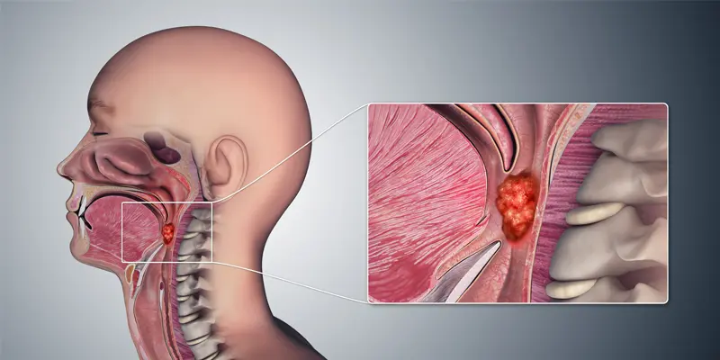 Tổng quan ung thư vòm họng