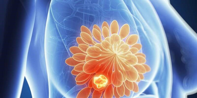 Ung thư vú là bệnh lý có thể gặp ở cả nam lẫn nữ