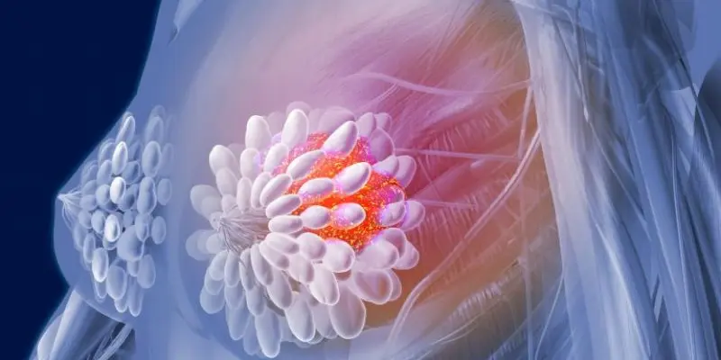 Ung thư vú di căn là tình trạng tế bào ung thư từ tuyến vú lan sang các cơ quan khác trong cơ thể. 