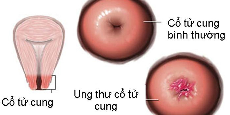 Hình ảnh ung thư cổ tử cung