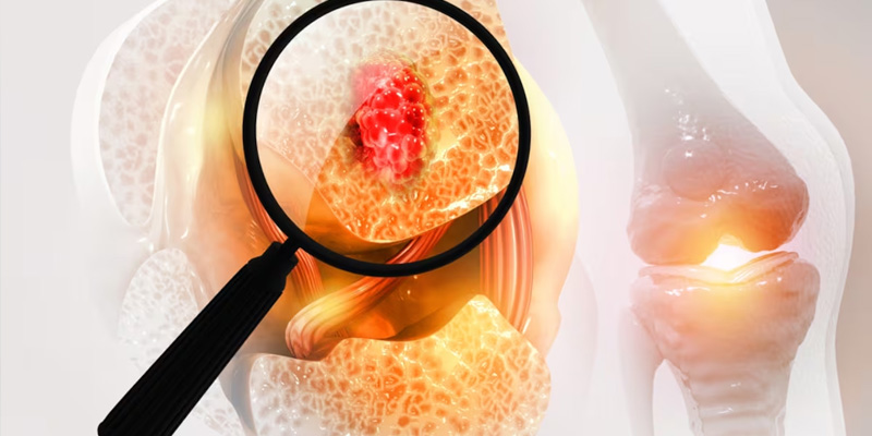 Ung thư phổi di căn xương có thể gây nhiều triệu chứng như đau nhức, gãy xương, tăng canxi máu, chèn ép tủy sống…