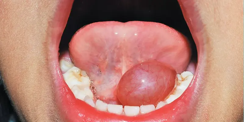 U nang dưới lưỡi quá to sẽ gâyra đau và khó nuốt