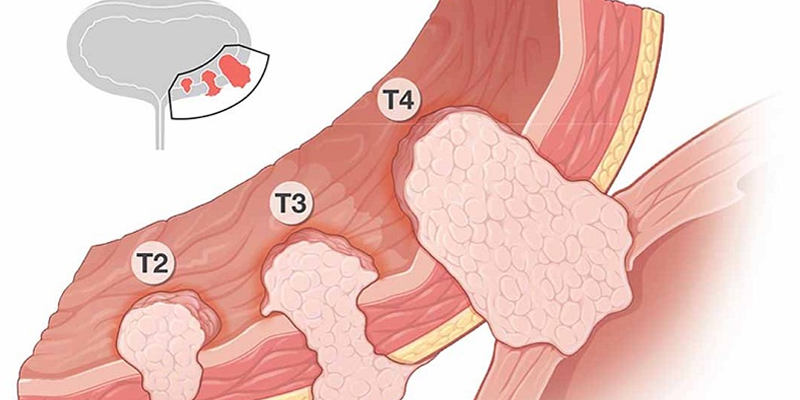 Dựa trên mức độ xâm lấn của khối u mà ung thư bàng quang được chia thành 4 giai đoạn
