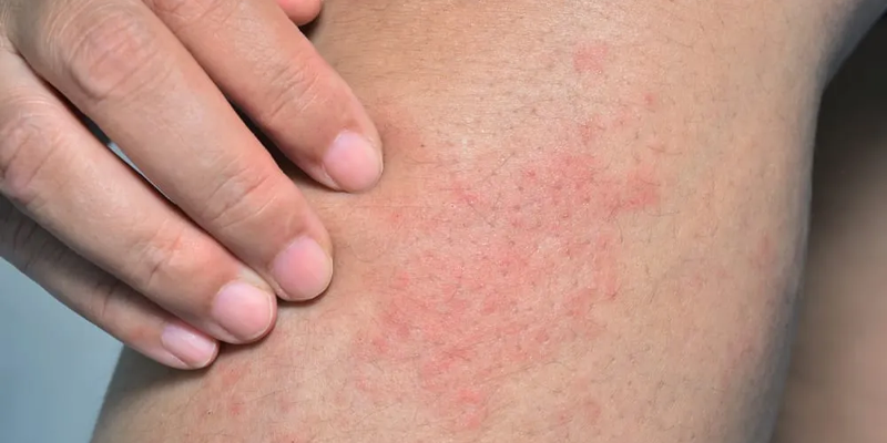 Triệu chứng ung thư máu giai đoạn đầu có dấu xuất huyết dưới da