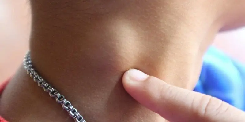 Triệu chứng ung thư vòm họng thường nổi hạch ở cổ