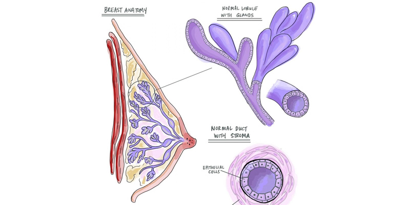 Ung thư vú tiểu thùy xâm nhập có thể không gây bất kỳ thay đổi rõ ràng nào tại vú