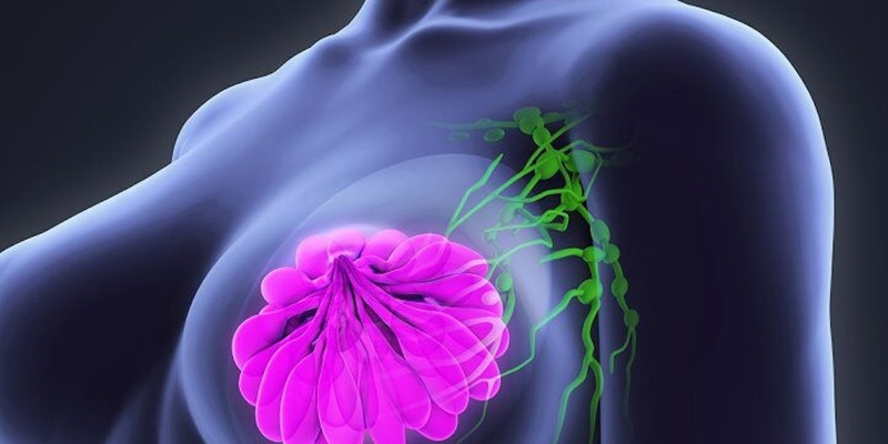 Ung thư vú là loại ung thư phổ biến nhất ở phụ nữ