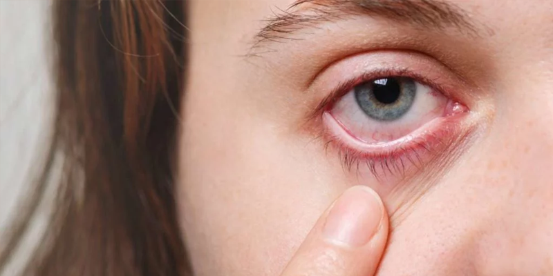 Bệnh u kết mạc mắt gây ra nhiều cảm giác khó chịu cho người bệnh